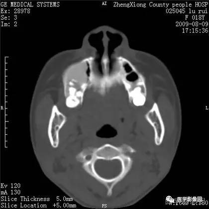 【病例】颌骨骨化性纤维瘤1例CT 【病例】颌骨骨化性纤维瘤1例CT