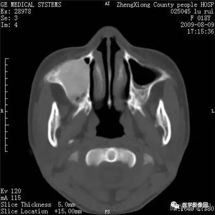 【病例】颌骨骨化性纤维瘤1例CT