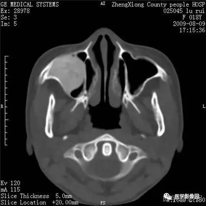 【病例】颌骨骨化性纤维瘤1例CT 【病例】颌骨骨化性纤维瘤1例CT