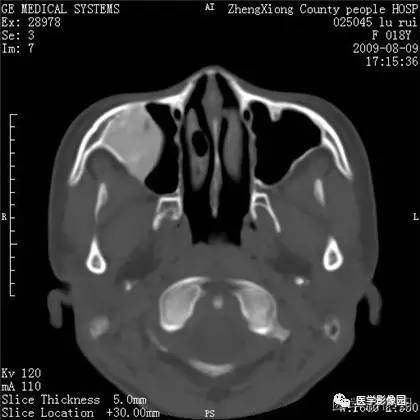 【病例】颌骨骨化性纤维瘤1例CT 【病例】颌骨骨化性纤维瘤1例CT