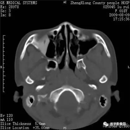 【病例】颌骨骨化性纤维瘤1例CT 【病例】颌骨骨化性纤维瘤1例CT