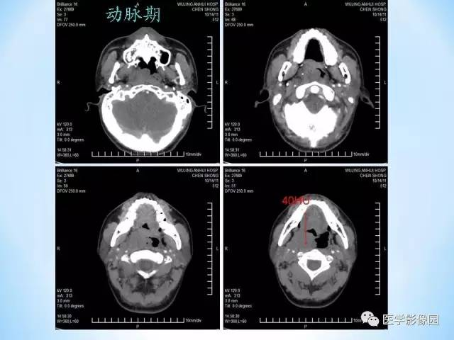 【病例】鼻咽部纤维血管瘤1例CT影像表现 【病例】鼻咽部纤维血管瘤1例CT影像表现