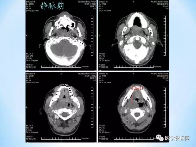 【病例】鼻咽部纤维血管瘤1例CT影像表现 【病例】鼻咽部纤维血管瘤1例CT影像表现