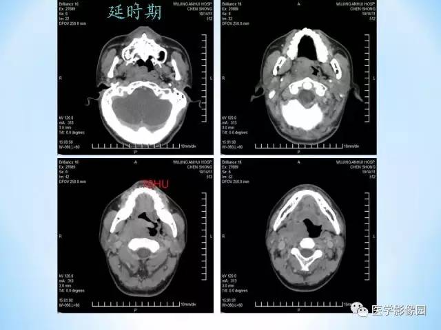 【病例】鼻咽部纤维血管瘤1例CT影像表现 【病例】鼻咽部纤维血管瘤1例CT影像表现
