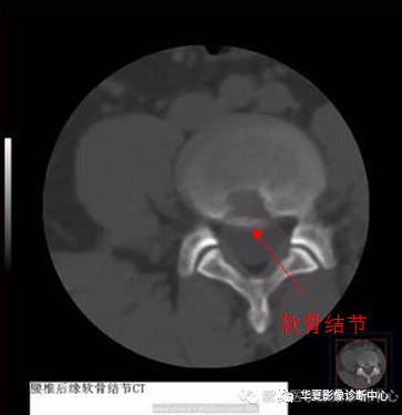 椎缘骨的影像学表现及命名 椎缘骨的影像学表现及命名