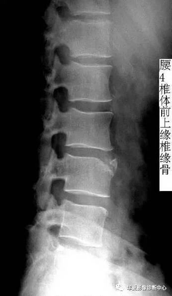 椎缘骨的影像学表现及命名 椎缘骨的影像学表现及命名