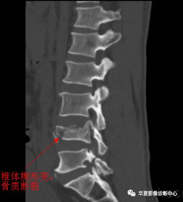 椎缘骨的影像学表现及命名 椎缘骨的影像学表现及命名