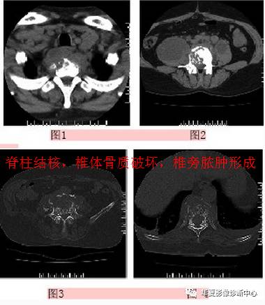 椎缘骨的影像学表现及命名 椎缘骨的影像学表现及命名