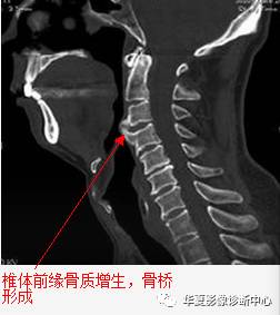 椎缘骨的影像学表现及命名 椎缘骨的影像学表现及命名