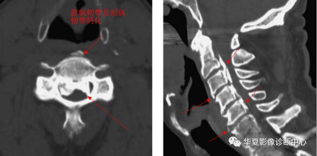 椎缘骨的影像学表现及命名 椎缘骨的影像学表现及命名
