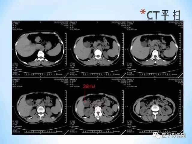 【病例】胆囊腺肌增生症1例CT