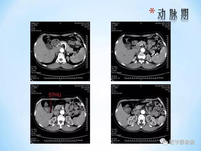【病例】胆囊腺肌增生症1例CT 【病例】胆囊腺肌增生症1例CT