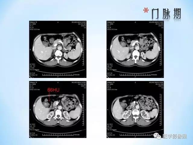 【病例】胆囊腺肌增生症1例CT 【病例】胆囊腺肌增生症1例CT