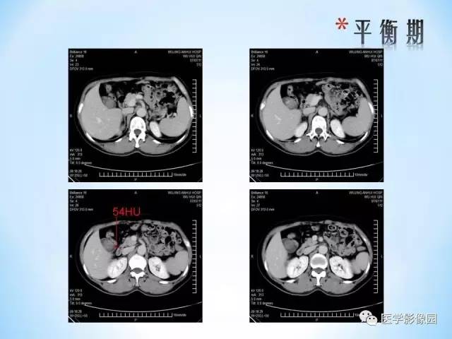 【病例】胆囊腺肌增生症1例CT 【病例】胆囊腺肌增生症1例CT