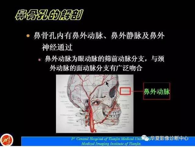 【PPT】鼻骨孔-鼻骨骨折诊断的误区