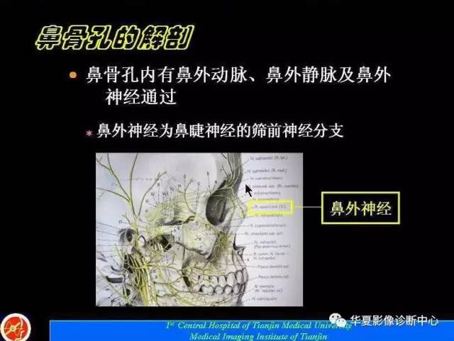 【PPT】鼻骨孔-鼻骨骨折诊断的误区