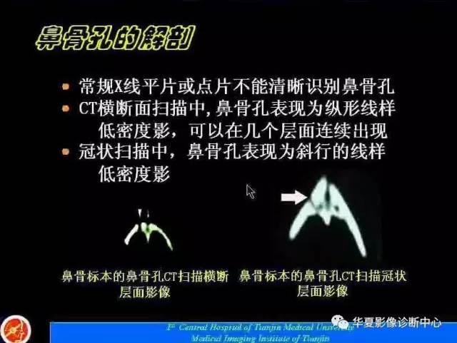 【PPT】鼻骨孔-鼻骨骨折诊断的误区