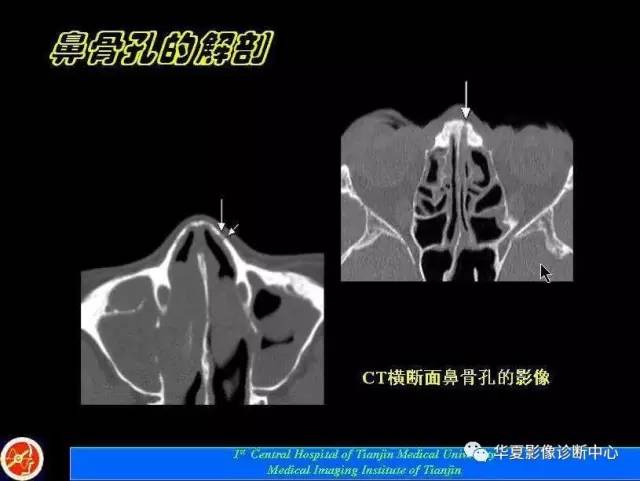 【PPT】鼻骨孔-鼻骨骨折诊断的误区