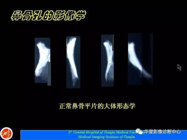 【PPT】鼻骨孔-鼻骨骨折诊断的误区