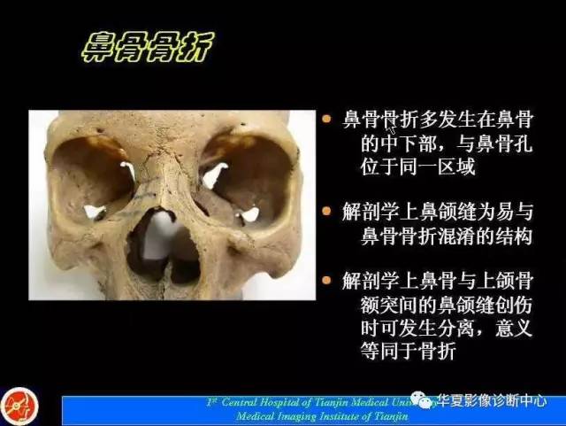【PPT】鼻骨孔-鼻骨骨折诊断的误区