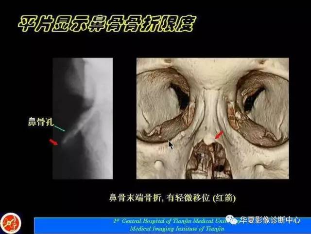 【PPT】鼻骨孔-鼻骨骨折诊断的误区