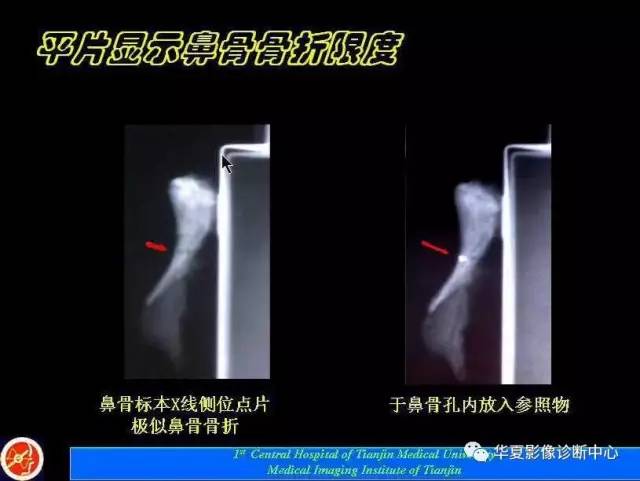 【PPT】鼻骨孔-鼻骨骨折诊断的误区