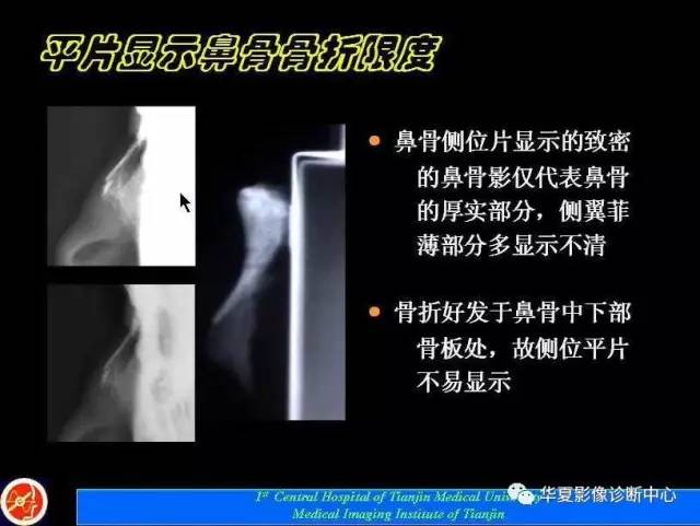 【PPT】鼻骨孔-鼻骨骨折诊断的误区