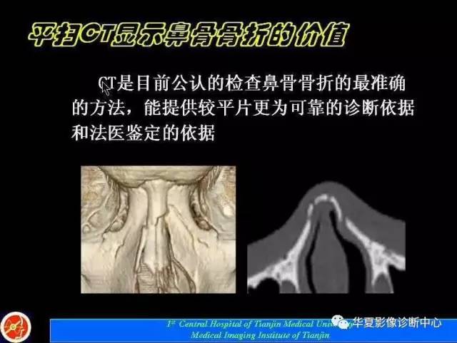 【PPT】鼻骨孔-鼻骨骨折诊断的误区