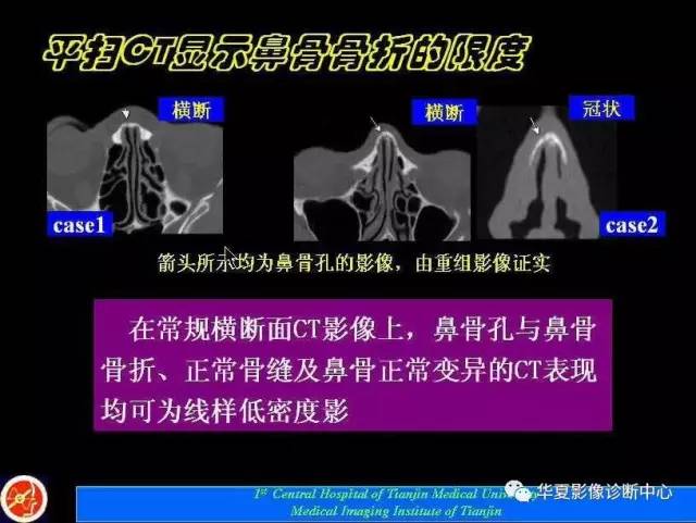 【PPT】鼻骨孔-鼻骨骨折诊断的误区