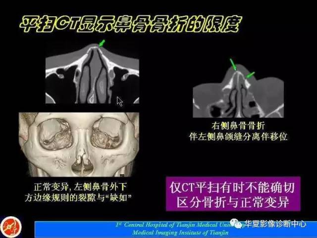 【PPT】鼻骨孔-鼻骨骨折诊断的误区