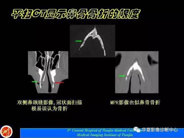 【PPT】鼻骨孔-鼻骨骨折诊断的误区