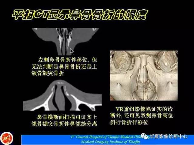 【PPT】鼻骨孔-鼻骨骨折诊断的误区