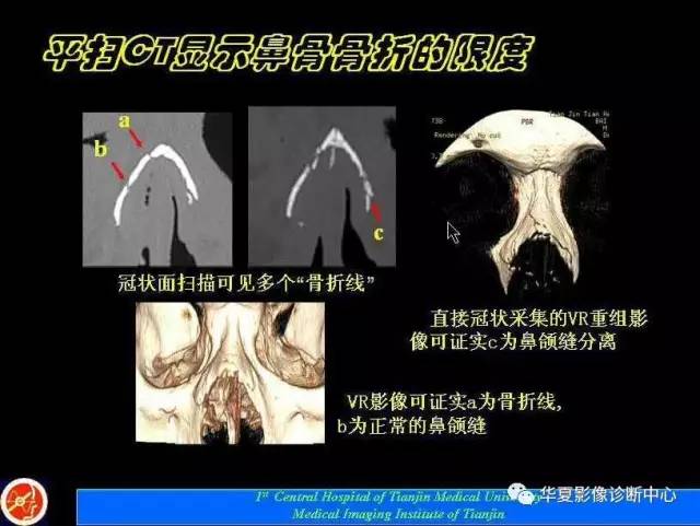 【PPT】鼻骨孔-鼻骨骨折诊断的误区