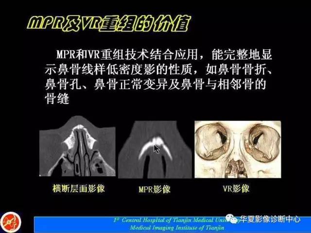 【PPT】鼻骨孔-鼻骨骨折诊断的误区