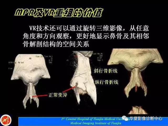 【PPT】鼻骨孔-鼻骨骨折诊断的误区