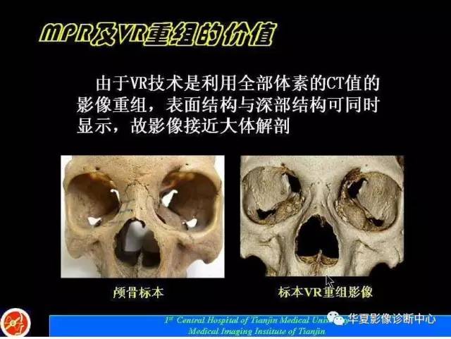 【PPT】鼻骨孔-鼻骨骨折诊断的误区