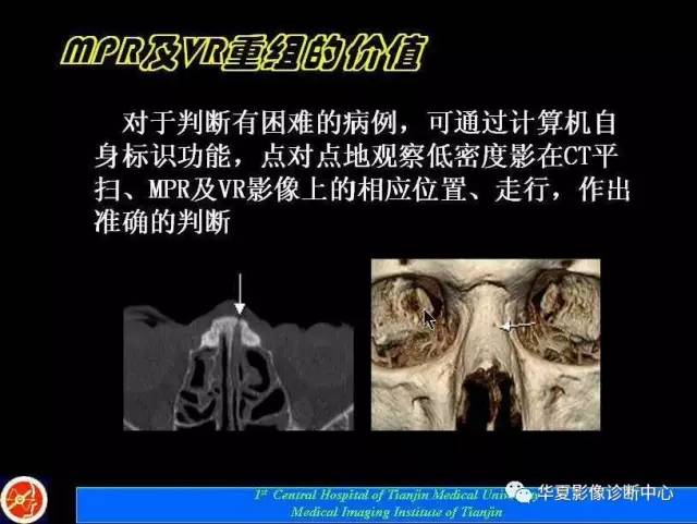 【PPT】鼻骨孔-鼻骨骨折诊断的误区