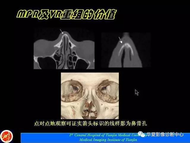 【PPT】鼻骨孔-鼻骨骨折诊断的误区
