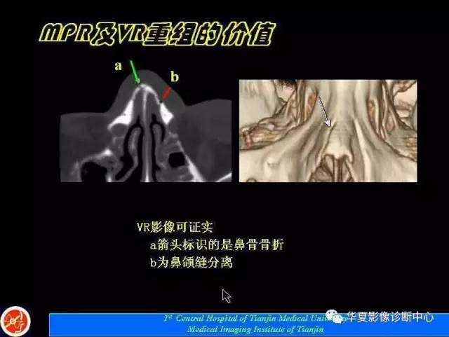 【PPT】鼻骨孔-鼻骨骨折诊断的误区