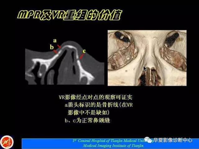 【PPT】鼻骨孔-鼻骨骨折诊断的误区
