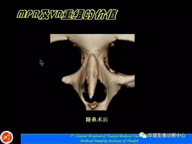 【PPT】鼻骨孔-鼻骨骨折诊断的误区