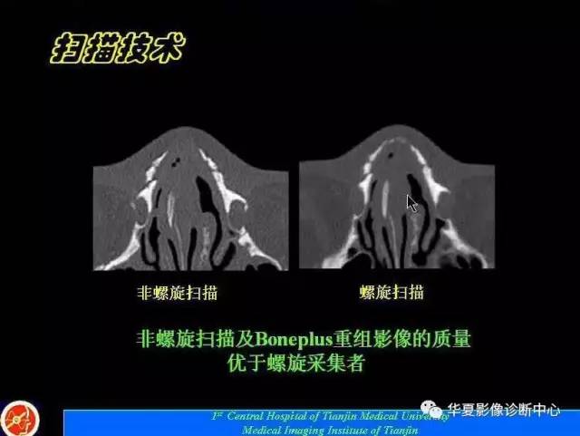 【PPT】鼻骨孔-鼻骨骨折诊断的误区