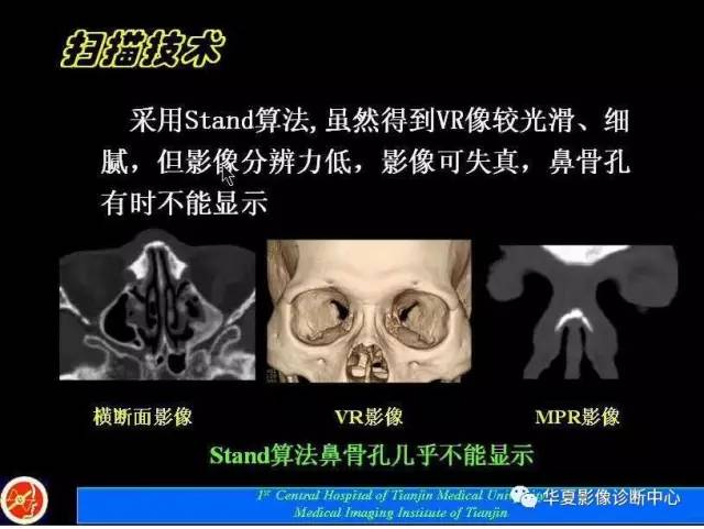 【PPT】鼻骨孔-鼻骨骨折诊断的误区