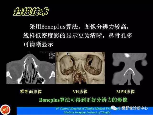 【PPT】鼻骨孔-鼻骨骨折诊断的误区