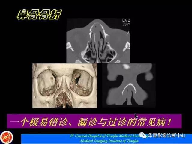 【PPT】鼻骨孔-鼻骨骨折诊断的误区