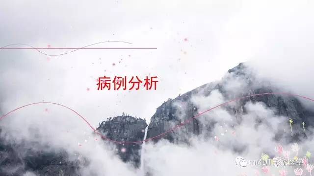 【PPT】原发性卵巢蒂扭转影像诊断