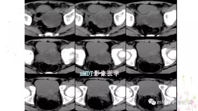 【PPT】原发性卵巢蒂扭转影像诊断