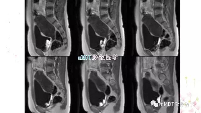 【PPT】原发性卵巢蒂扭转影像诊断