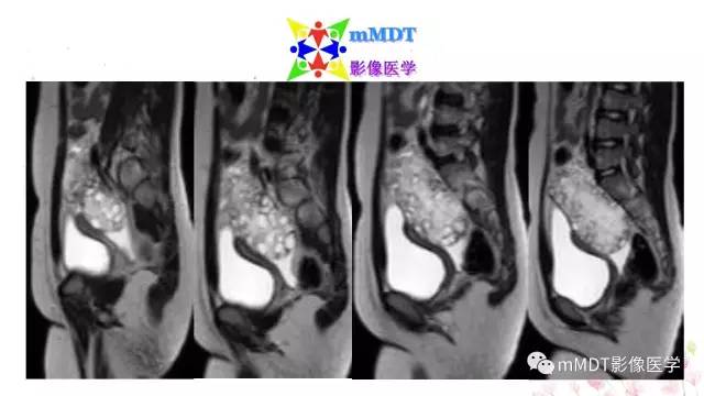 【PPT】原发性卵巢蒂扭转影像诊断