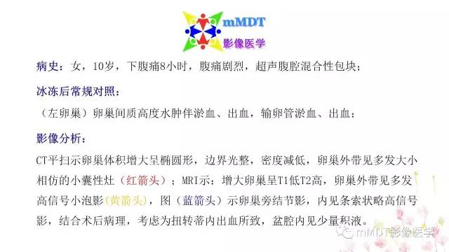 【PPT】原发性卵巢蒂扭转影像诊断